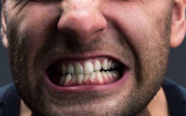¿Aprietas los dientes sin darte cuenta? Estas son las señales del bruxismo y cómo tratarlo